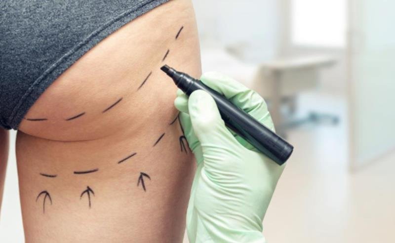 Dr. Octávio Curi Frascareli – O que é Lipoenxertia e por que tem sido tão procurada?