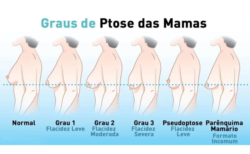 Dr. Octávio Curi Frascareli – Seios caídos após amamentação: por que acontece e quando a cirurgia pode ajudar