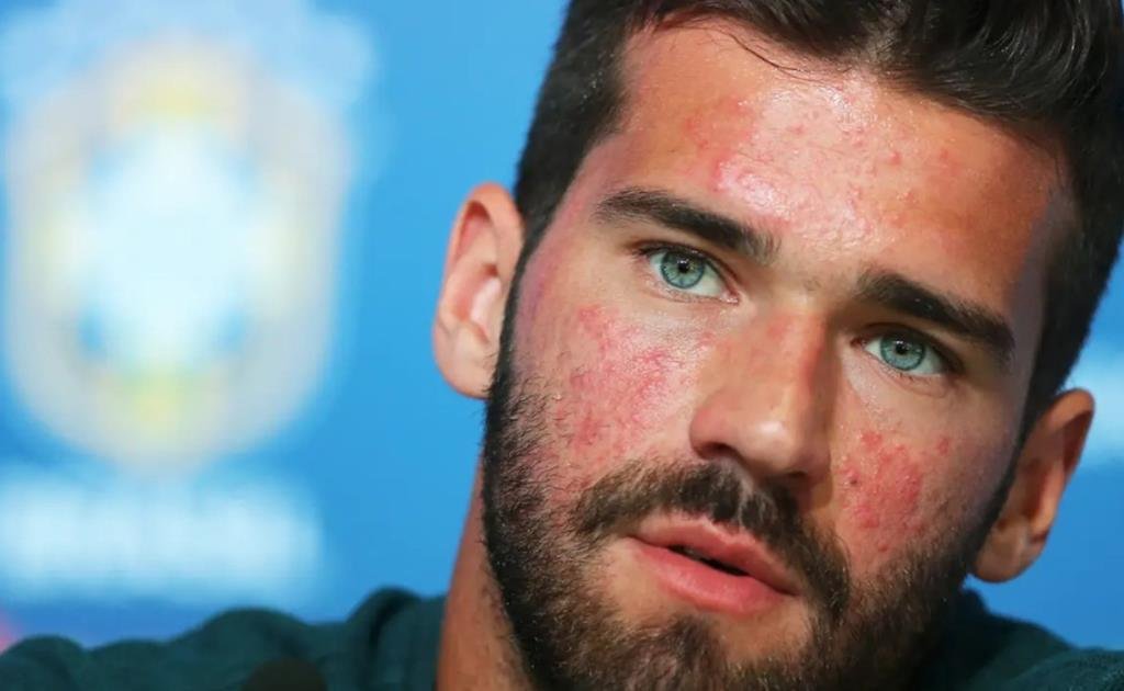 O que é a Rosácea? Dermatologista explica doença revelada pelo goleiro Alisson Becker